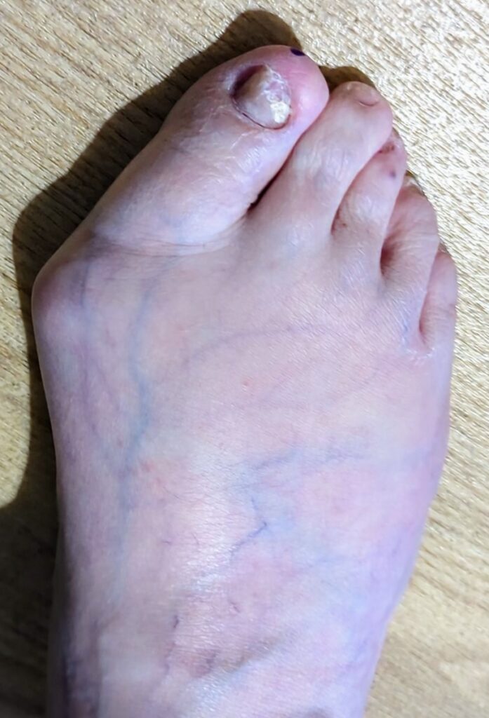 Bunions 11 download 8 1746557713861.jfif2 b4d761f9705f8b36b5d548a5b7427df4