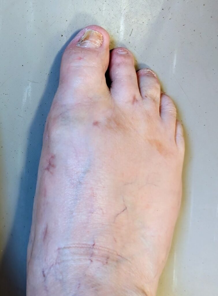 Bunions 12 download 9 1746557580530.jfif2 a114856f42893d05c20c64f01060350d